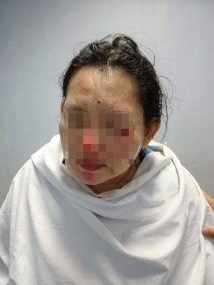 Tas Berisi Uang dan HP Dirampas, Ibu di Pangkalpinang Terluka Parah Diseret Jambret